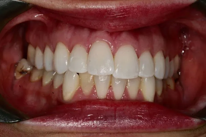 Patient's teeth before smile makeover at Libert Lake Smile Source.